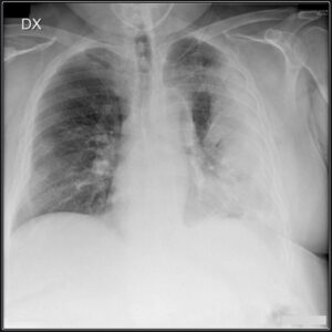 Radiografia con polmonite